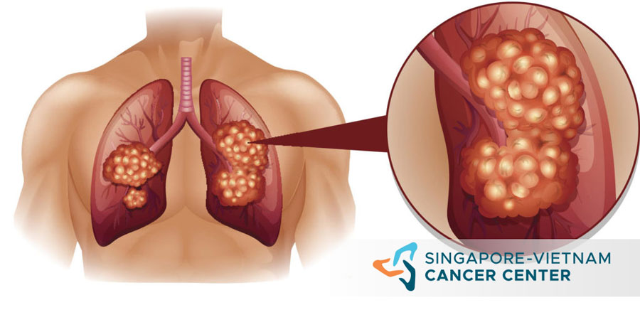 minh họa ung thư phổi